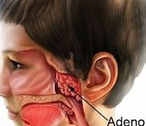Image result for adenoifes