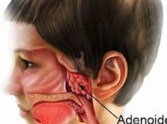 Image result for ademoides