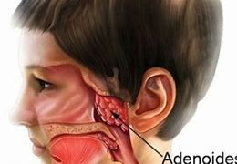 Image result for adenoidea