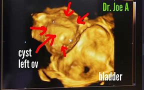 Image result for 4 Cm Ovarian Cyst Symptoms