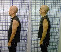 Image result for Chiropractor Back Before and After