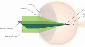 Image result for Examples of Astigmatism Vision
