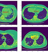 Image result for Lung Cancer Nodule Size