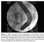 Image result for ERCP Chronic Pancreatitis