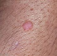 Image result for Wart On Arm