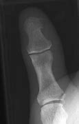Image result for Broken Thumb