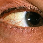 Image result for Film Swelling around Pupil
