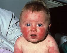 Image result for Children Skin Diseases