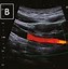 Image result for Carotid Dissection Ultrasound Images