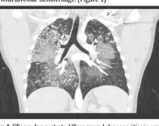 Image result for Iph in Adults