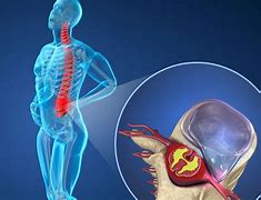 Image result for herniarse