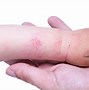 Image result for Allergic Eczema