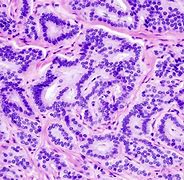 Image result for Carcinoid Tumor Gross