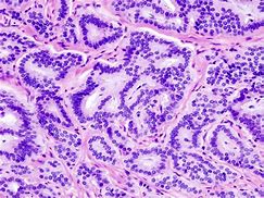 Image result for Gastrointestinal Carcinoid Tumor