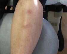 Image result for Leg Bumps Under Skin