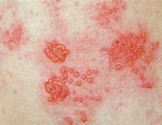 Image result for Zoster Rash