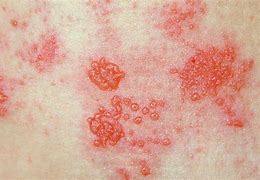 Image result for Shingles Early Stages