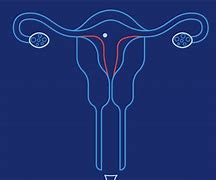 Image result for Heavy Implantation Bleeding