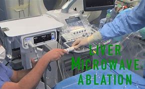 Image result for Microwave Ablation Liver