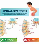 Image result for Degenerative Lumbar Spinal Stenosis