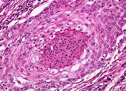 Image result for Skin Cancer Under Microscope