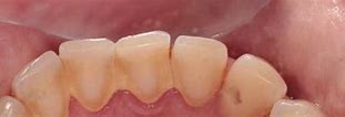 Image result for Shredded Floss Stuck in Teeth