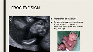 Image result for Frog Eye Sign Anencephaly