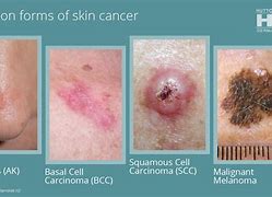 Image result for What Do Different Types of Skin Cancer Look Like