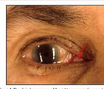 Image result for Caruncle Papilloma
