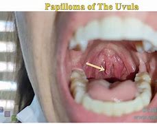 Image result for Papilloma On Uvula