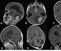 Image result for Posterior Fossa Meningioma Tumor Illustrations