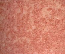 Image result for Penicillin Allergy Rash Pictures
