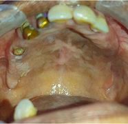 Image result for Squamous Papilloma of Palate