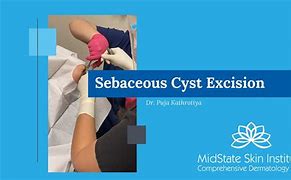 Image result for Sebaceous Cyst