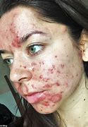 Image result for Bad Acne On Face