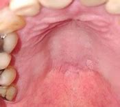 Image result for Papilloma On Buccal Gingival