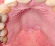 Image result for Squamous Cell Papilloma Tongue
