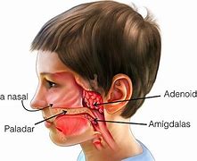 Image result for adenoidee