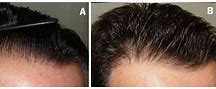 Image result for How Long Do Hair Transplants Last