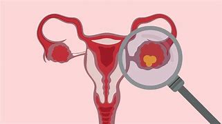 Image result for Follicular Cyst Ovary