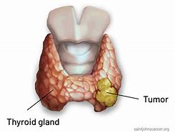Image result for Thyroid Tumor