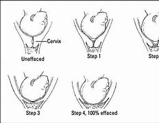 Image result for Stages of Labor Dilation