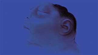Image result for Degree of Anencephaly