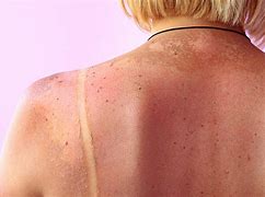 Image result for Sun Spots vs Skin Cancer