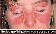 Image result for Red Skin Rash On Face