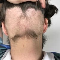Image result for alopecis