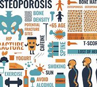 Image result for Bone Mineral Density Osteoporosis