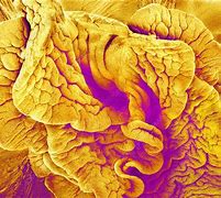 Image result for Cyst On Fallopian Tube