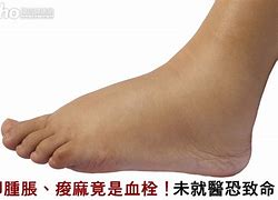 Image result for Extra Wide Shoes for Swollen Feet