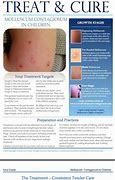 Image result for Molluscum Contagiosum Liquid Nitrogen Treatment